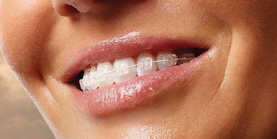 Aparatul dentar – mai este cazul sa ne temem de el?